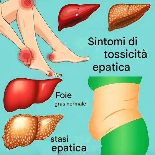 11 segnali che il tuo fegato non funziona bene e le tossine si accumulano nel tuo corpo