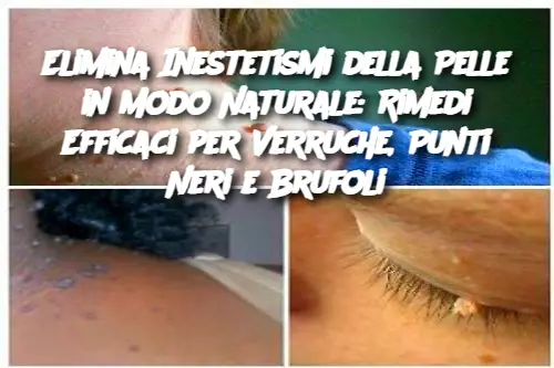 Elimina Inestetismi della Pelle in Modo Naturale: Rimedi Efficaci per Verruche, Punti Neri e Brufoli