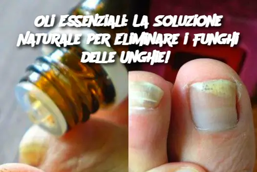 Oli Essenziali: La Soluzione Naturale per Eliminare i Funghi delle Unghie! 