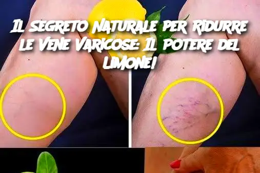 Il Segreto Naturale per Ridurre le Vene Varicose: Il Potere del Limone!