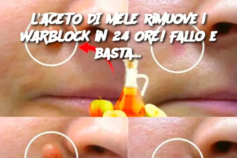 L'ACETO DI MELE rimuove i WARBLOCK in 24 ORE! Fallo e basta…