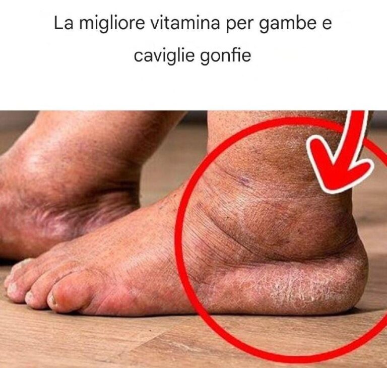 La migliore vitamina per gambe e caviglie gonfie