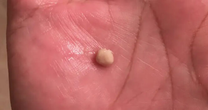 Cosa dovresti sapere sui calcoli tonsillari