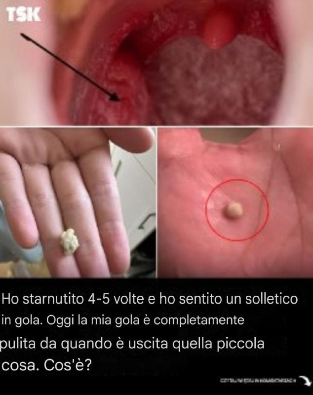 Ecco cosa devi sapere sui calcoli tonsillari