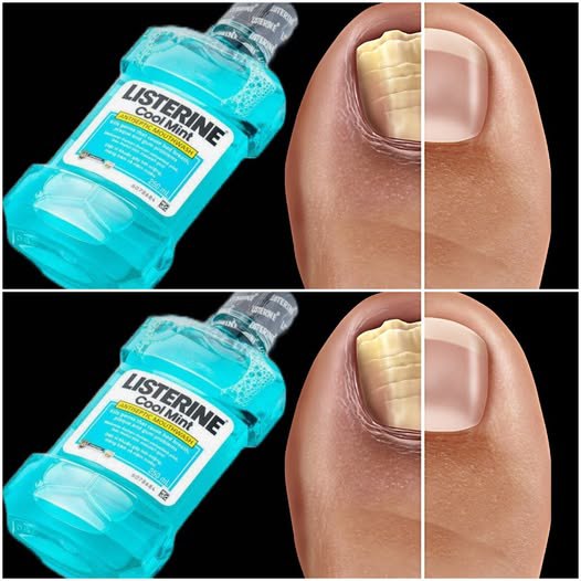 Questa semplice ricetta ti aiuterà a liberarti per sempre dai funghi alle unghie! Usare il collutorio