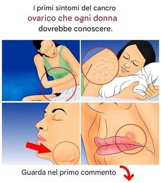I primi sintomi del cancro ovarico che ogni donna dovrebbe conoscere.