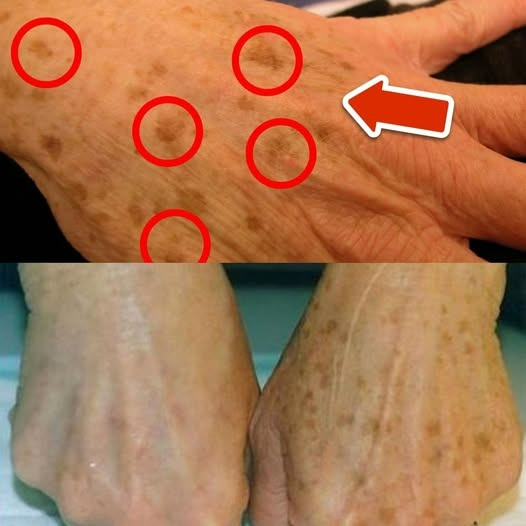 La migliore vitamina per la rimozione delle macchie dell'età