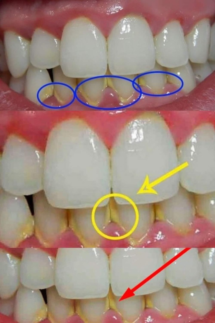 "Rimuovi la placca in 5 minuti in modo naturale, senza andare dal dentista! Scopri questo segreto per un sorriso smagliante.