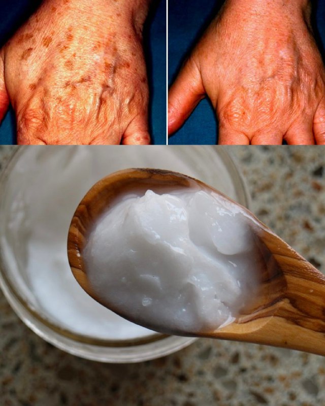 La mia crema fatta in casa è la più potente per ringiovanire le mani, contro rughe e macchie della pelle. La preparo in 5 minuti e la tengo in posa per 15.