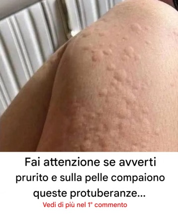 Perché compaiono le orticarie sulla pelle? Ecco i fattori sorprendenti che potresti non conoscere.