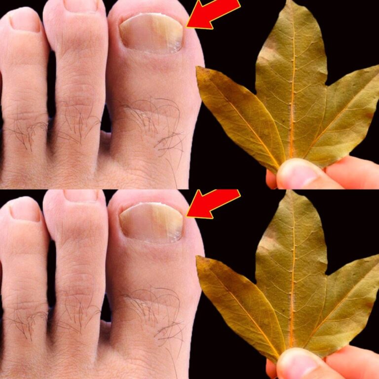 Elimina l'onicomicosi all'istante con le foglie di alloro! Basta sprecare soldi in farmacia!