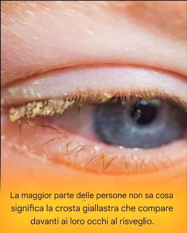 Crosta gialla al risveglio: cosa significa?