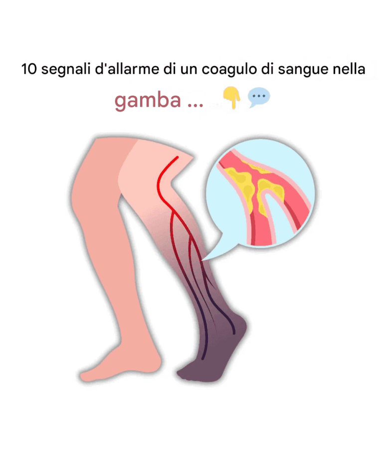 I 10 principali segnali di un COAGULO DI SANGUE nella gamba (prevenire la trombosi venosa profonda)