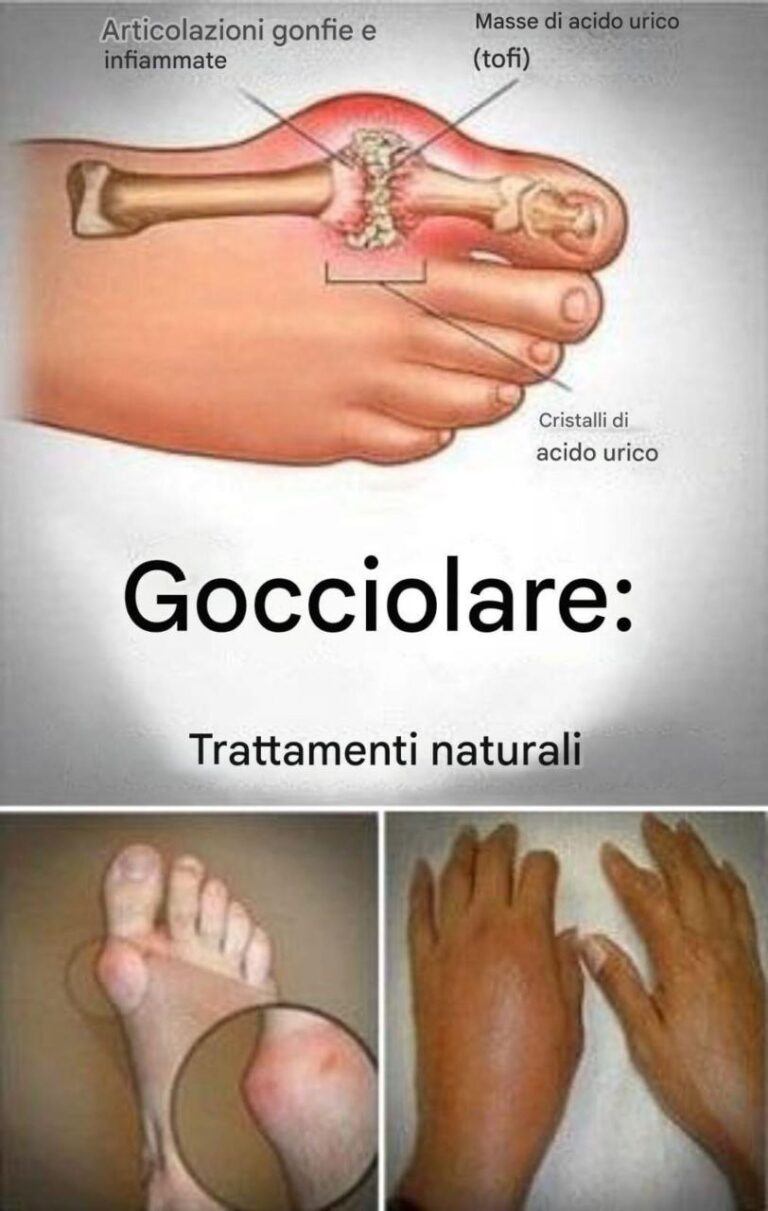 Dite addio alla gotta per sempre con questo potente trattamento naturale!