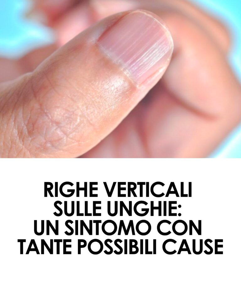 Sai cosa significano quelle righe verticali sulle tue unghie? Ecco le cause e come puoi curarle