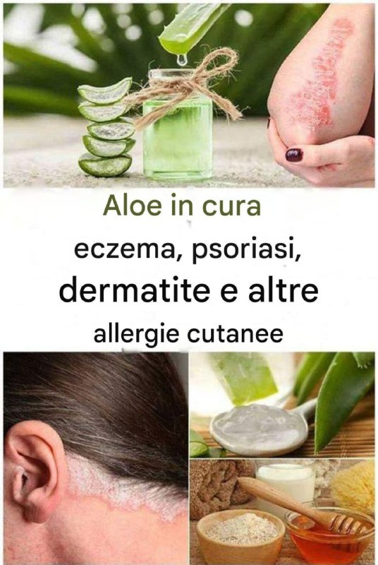 Aloe Vera per eczema, psoriasi, dermatite e altre allergie cutanee