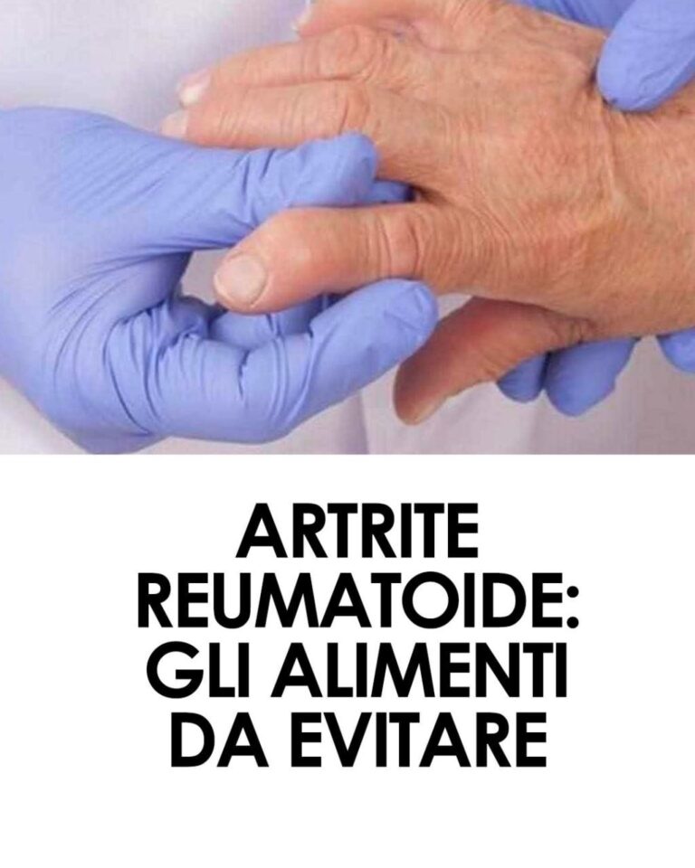 Il cibo ha un ruolo fondamentale per chi soffre di artrite reumatoide. Ecco gli alimenti da evitare