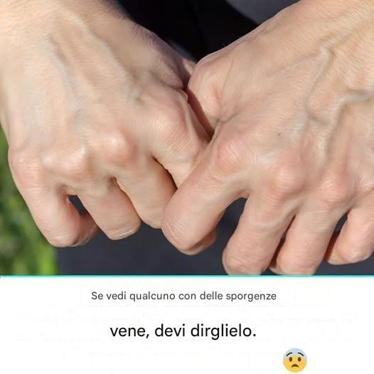 Perché le mie vene sono diventate improvvisamente visibili e gonfie?