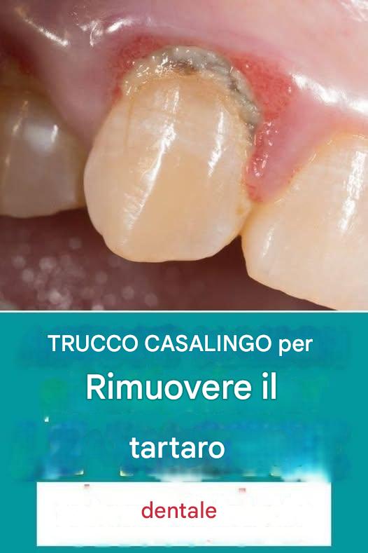 Un consiglio fai da te per rimuovere il tartaro