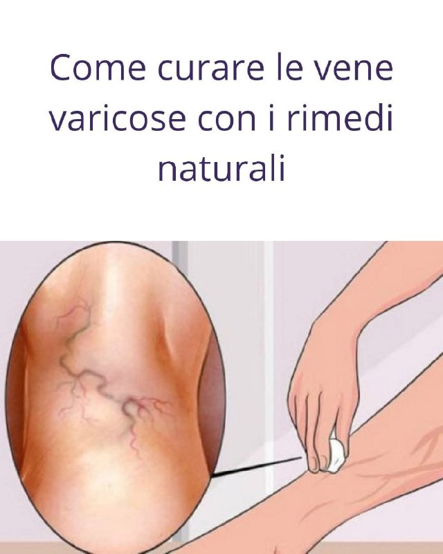 Vene leggere e gambe sane: i migliori rimedi naturali contro le vene varicose