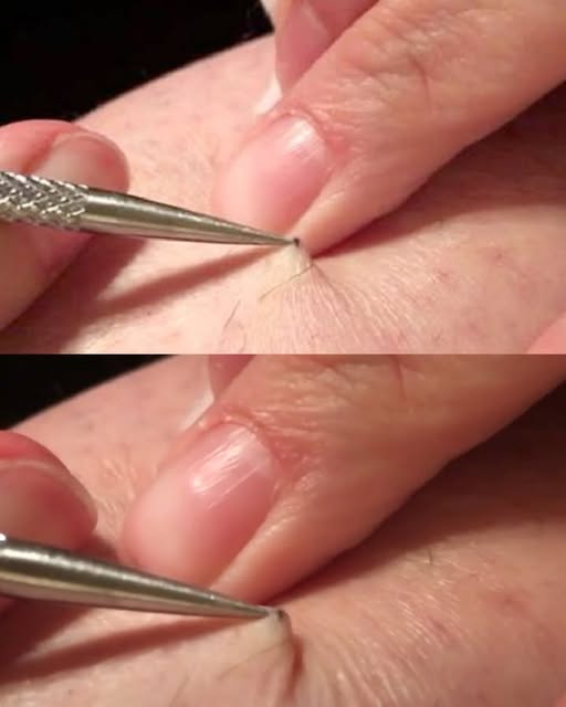 Tutto è iniziato con un prurito e, alla fine, uno shock! Un uomo ha trovato un punto nero sulla gamba e ha iniziato a grattarlo… quello che è riuscito a rimuovere ha lasciato milioni di persone senza parole.