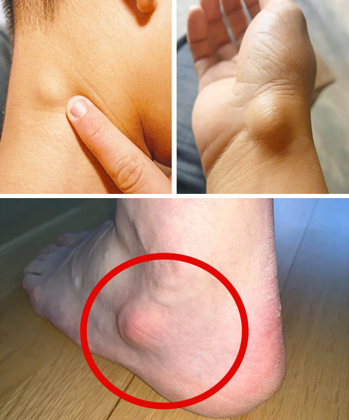 Cisti sinoviale del polso: cause, sintomi, dolore, trattamenti