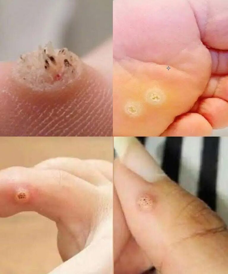 Fai molta attenzione: se noti questa crescita della pelle, potrebbe essere grave