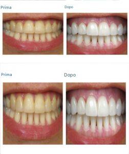 Come sbiancare i denti in modo naturale usando l'olio dell'albero del tè