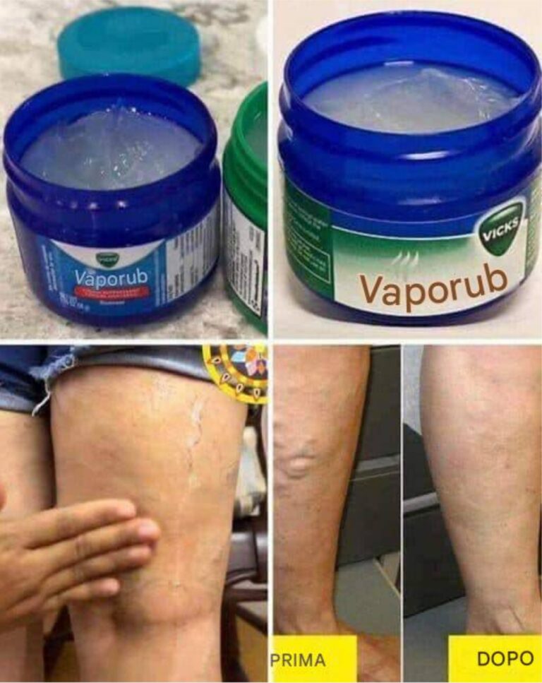 Ho 35 anni e le mie cosce e gambe erano ricoperte di vene varicose